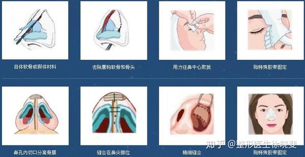鼻部整形常见的21种类型