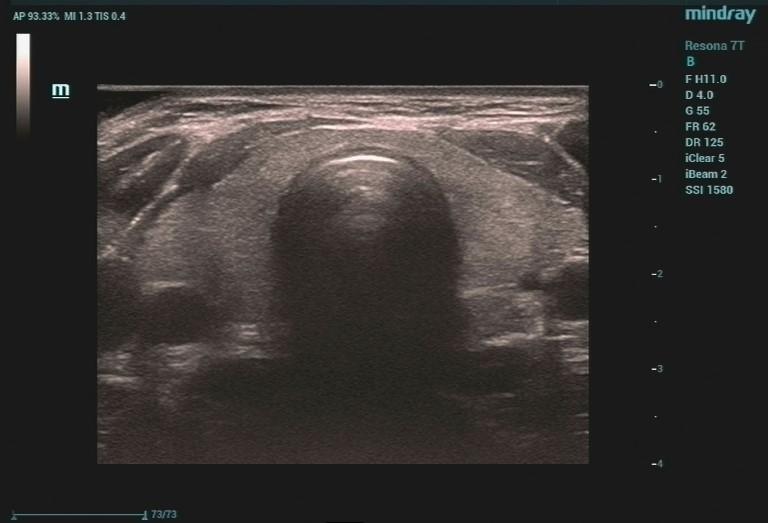 超声入门正常甲状腺超声表现