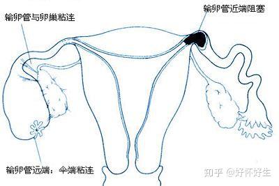 輸卵管堵塞不孕一定要做試管嬰兒嗎