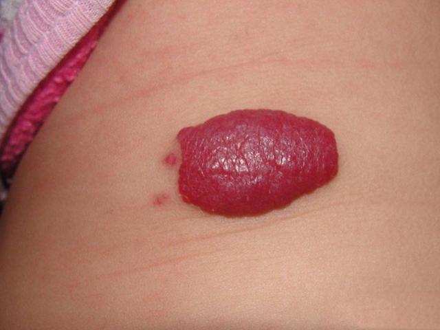 新生儿红色血管瘤图片图片