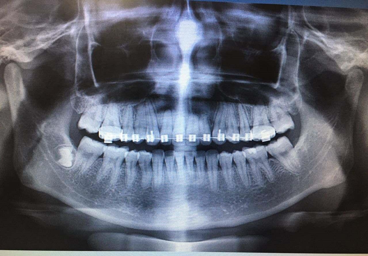 牙结石是什么？_牙科诊疗中心_顺德德伦口腔医院