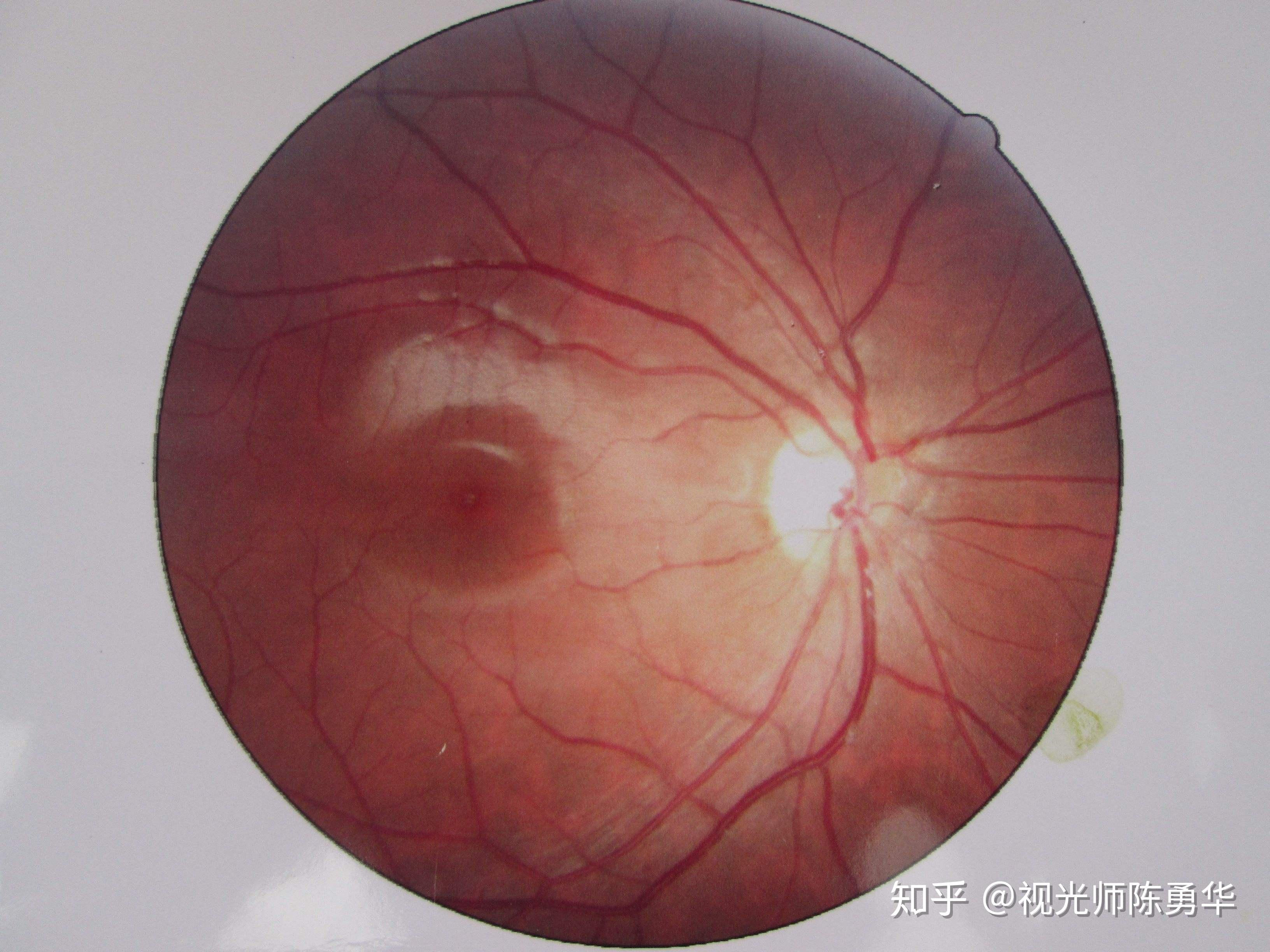 解析-眼底之豹纹状视网膜 - 知乎