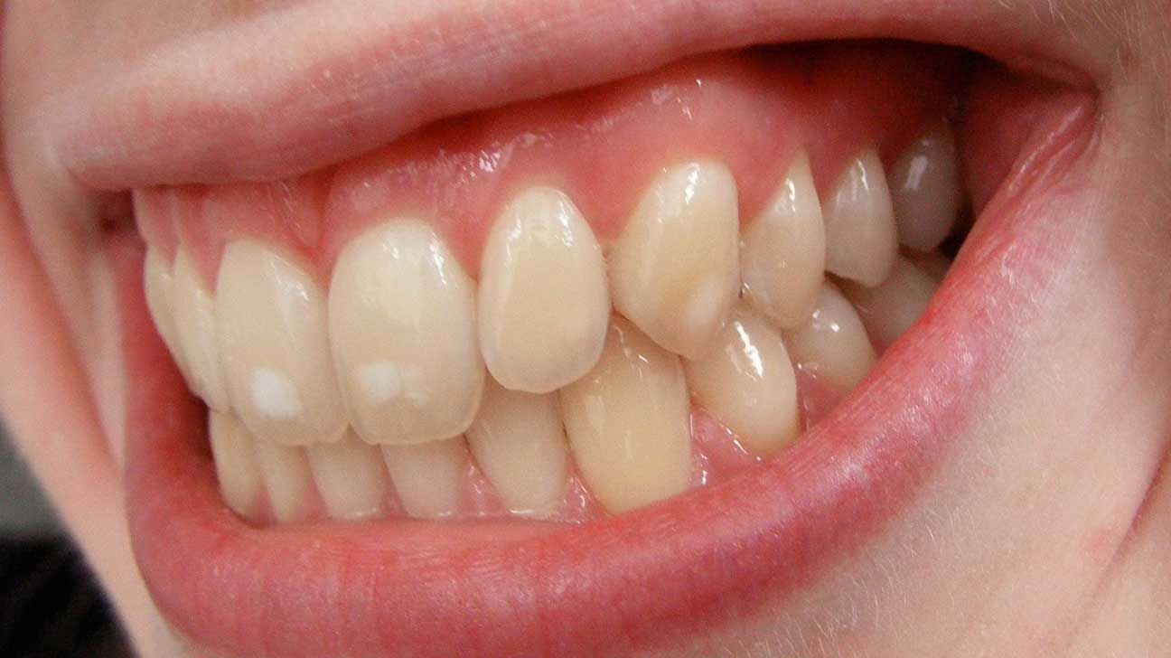 牙齿出现的白点是怎么回事
