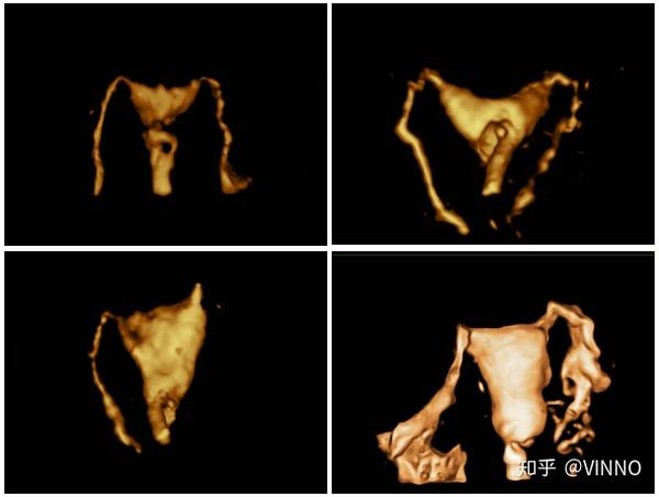 世界首例试管婴儿42岁了,迟到的礼物更是惊喜