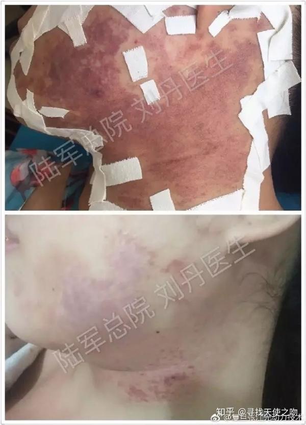 脉冲染料激光或老一代光敏剂治疗无效那海姆泊芬光动力有效吗