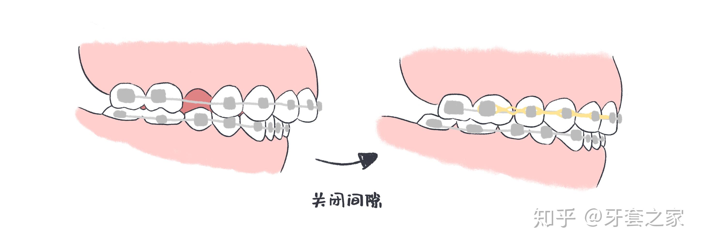 西安牙齿矫正：磨牙远移的同时关闭牙齿间隙 - 知乎