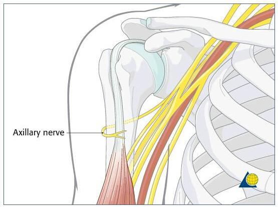 腋神经损伤后形成方肩畸形