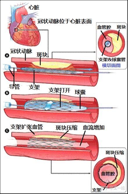 胡大一非急性心肌梗死的支架使用获益极小相当于安慰剂