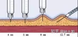 皮下注射就是打“三角肌”吗?解答皮下注射的10个临床问答 - 知乎