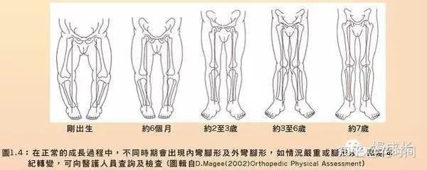 寶寶腿不直就是o型腿需矯正別讓以訛傳訛忽悠了你