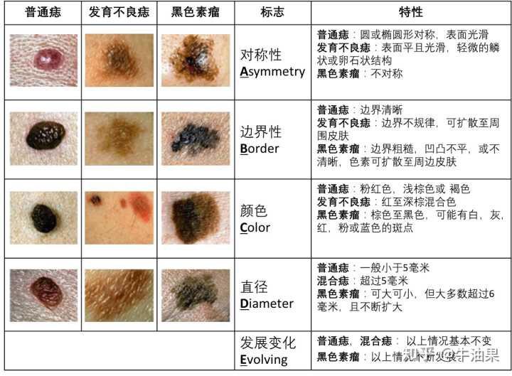 我的痣会变成黑色素瘤吗?大量图例看完就懂 - 知乎