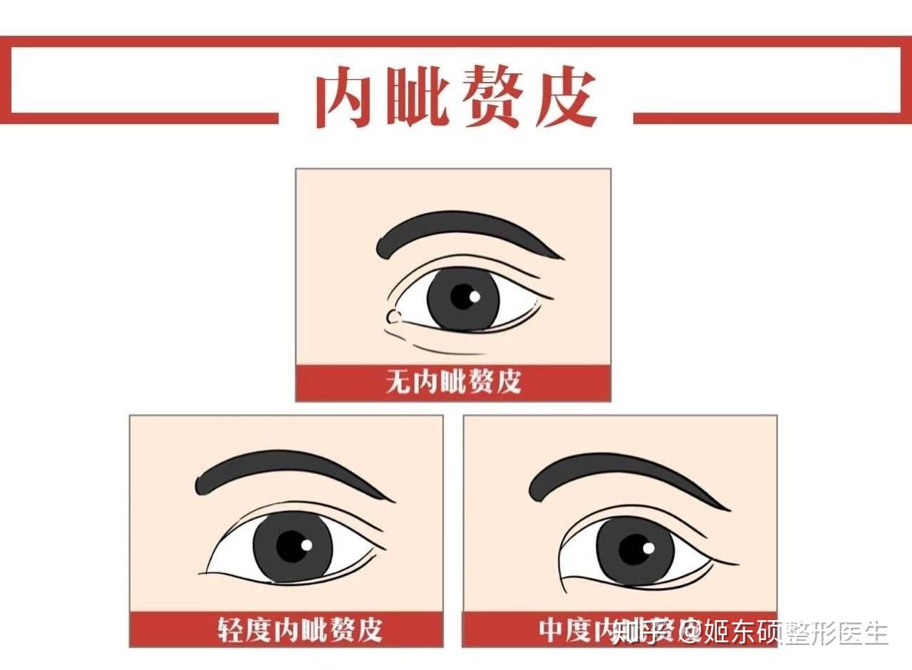 双眼皮形状分类！为什么不主张中国人做欧式平行双眼皮？ - 知乎