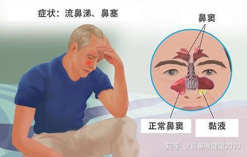 在各種鼻竇炎中,上頜竇炎多見,依次為篩竇,額竇和蝶竇的炎症.