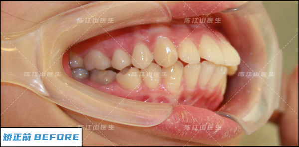 骨性龅牙侧面图图片