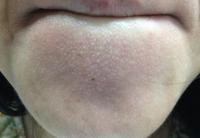 闭合性粉刺,民间俗称:闭口,白头. 大白话