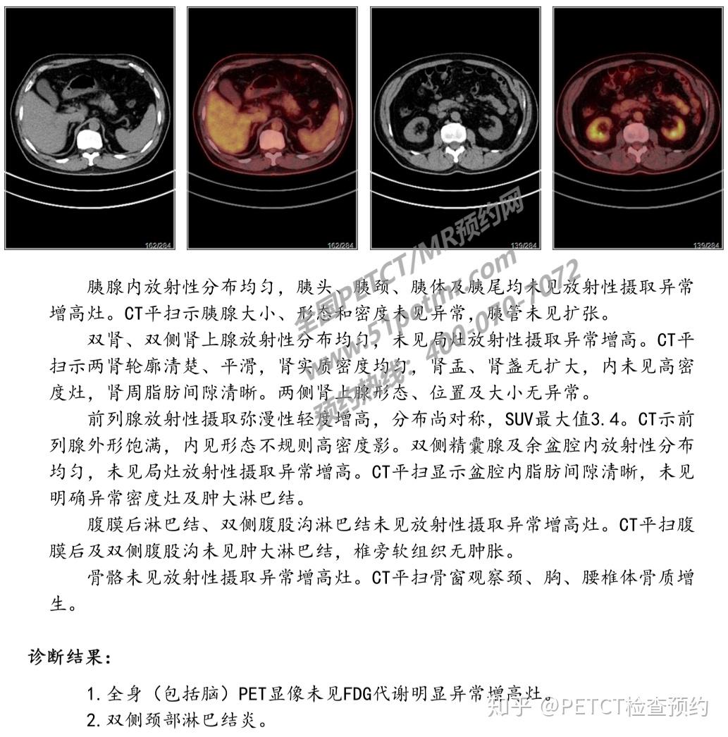 高端体检癌症筛查PETCT检查案例-全国PETCT/MR（核磁）检查预约网 - 知乎