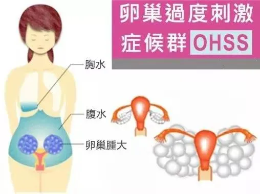 錯誤案例亂打絨促性素導致卵巢過度刺激綜合症