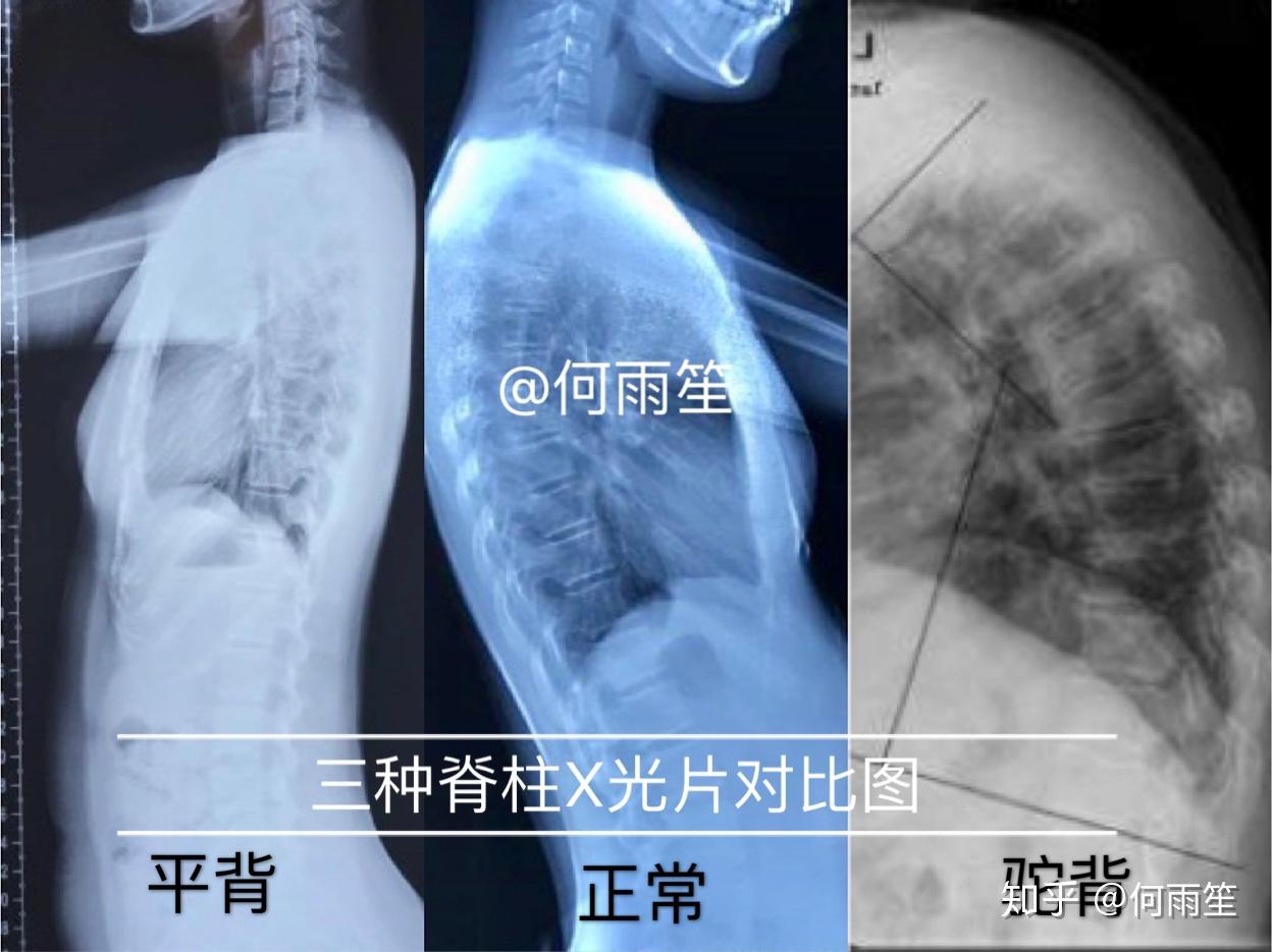 我们如何一步步把自己的脊柱弄歪的?(一) - 知乎