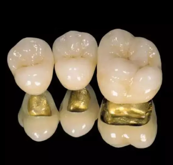 牙冠、烤瓷冠、全瓷冠，和贴面 知乎