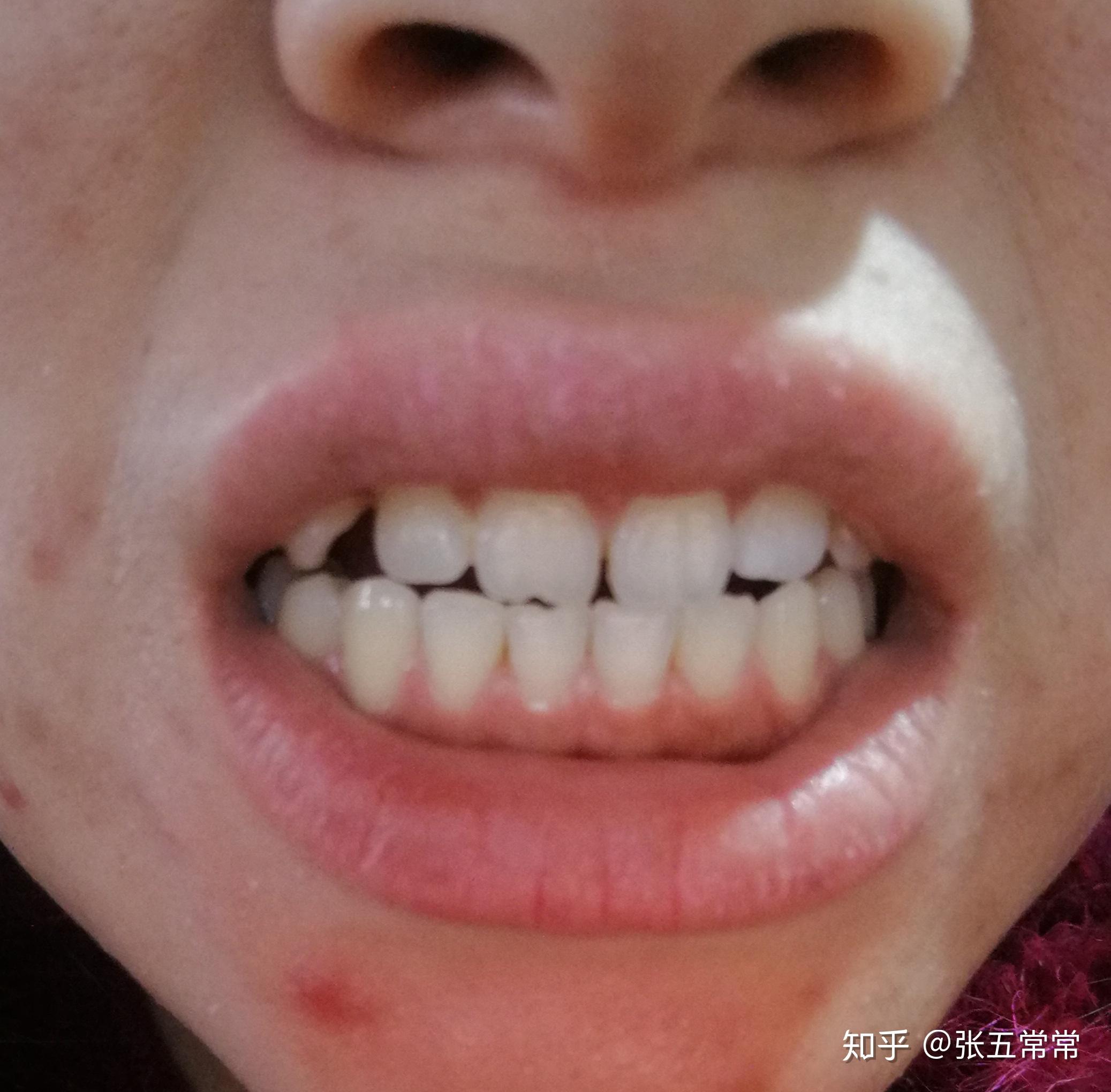 前牙外伤后美塑树脂美学重建——刘靖晋医生-北京固琦健康科技有限公司