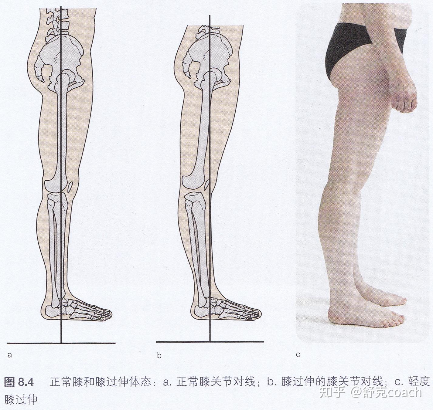 科学网—膝关节骨性关节炎主要有哪三大临床表现？ - 高绪仁的博文