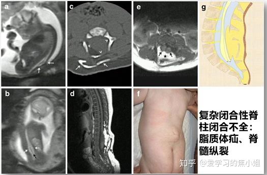 我国出生缺陷最常见的畸形：中枢神经系统畸形，99发生在胚胎期！ 知乎 4172