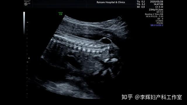 胎儿脊髓圆锥位置图片