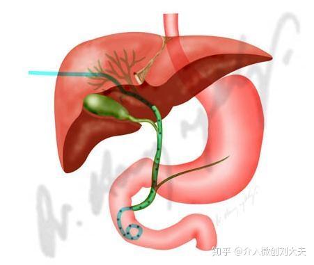 胰头增大胆管扩张图片