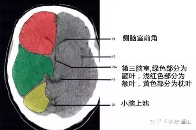 解剖&影像 —— 颅脑CT解剖口诀及彩色解剖图 - 知乎