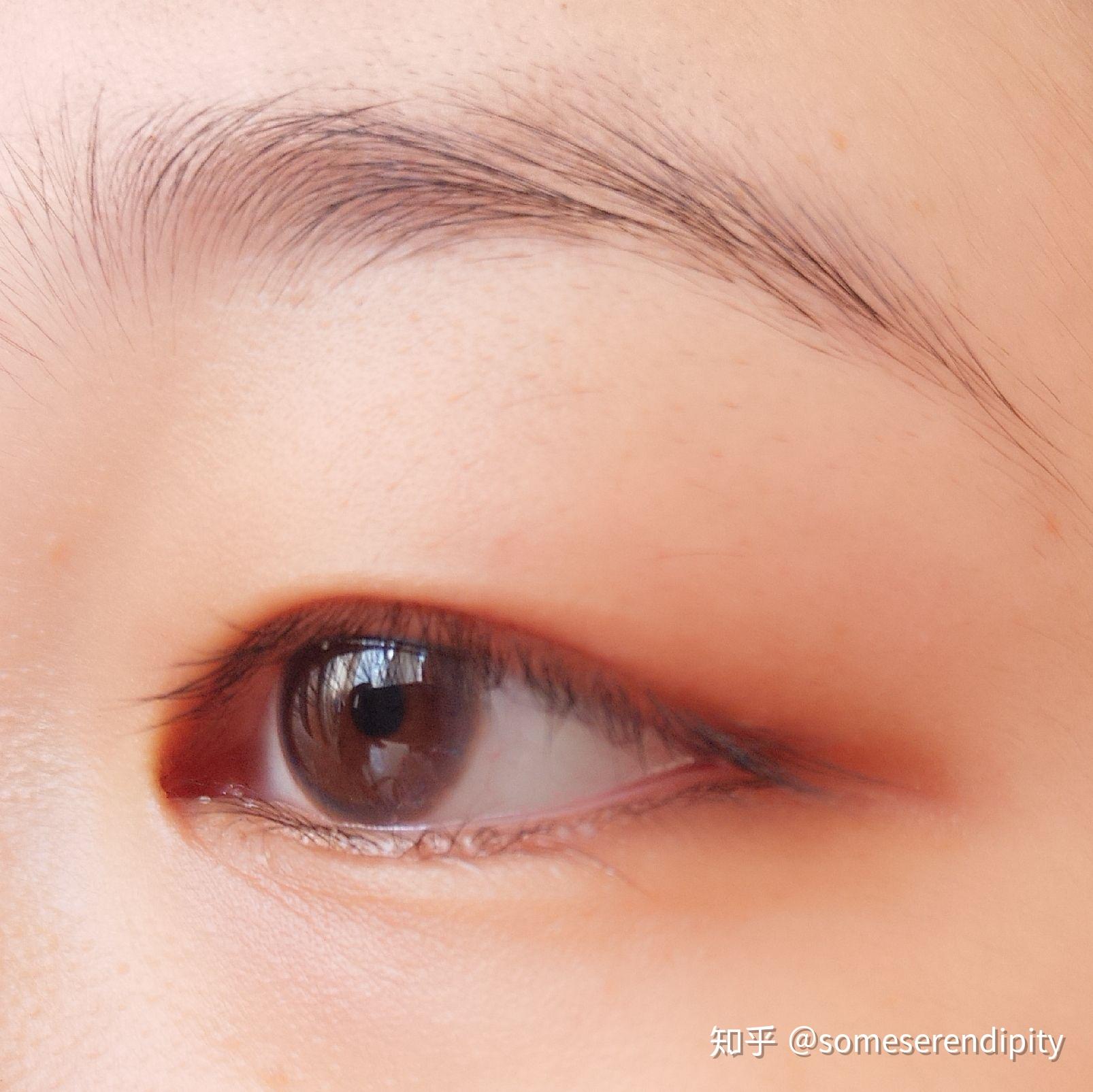 天生肿眼泡的眼综手术30day恢复记录_哔哩哔哩_bilibili