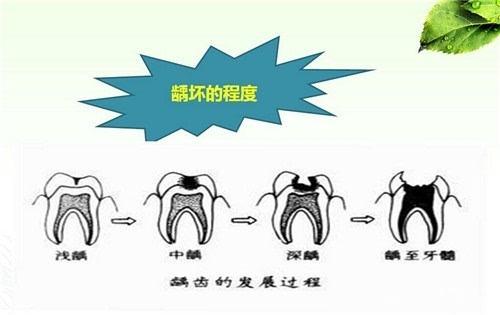 什么是龋齿为什么会出现龋齿