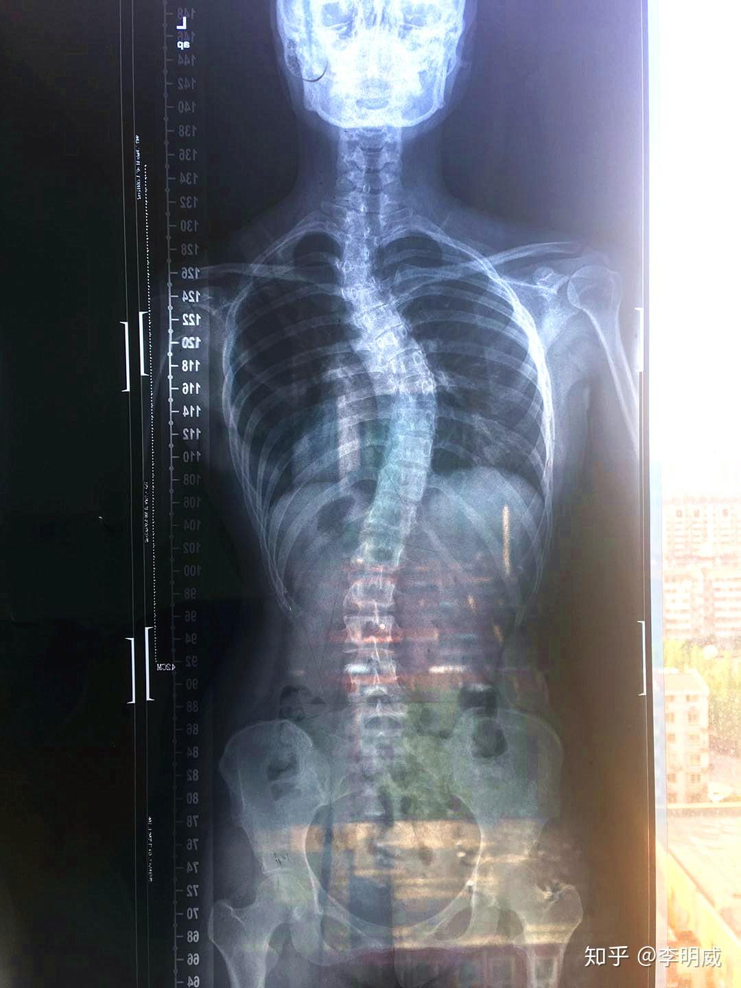 脊柱侧弯案例分析：3个月减少5°（附X光片、训练建议） - 知乎