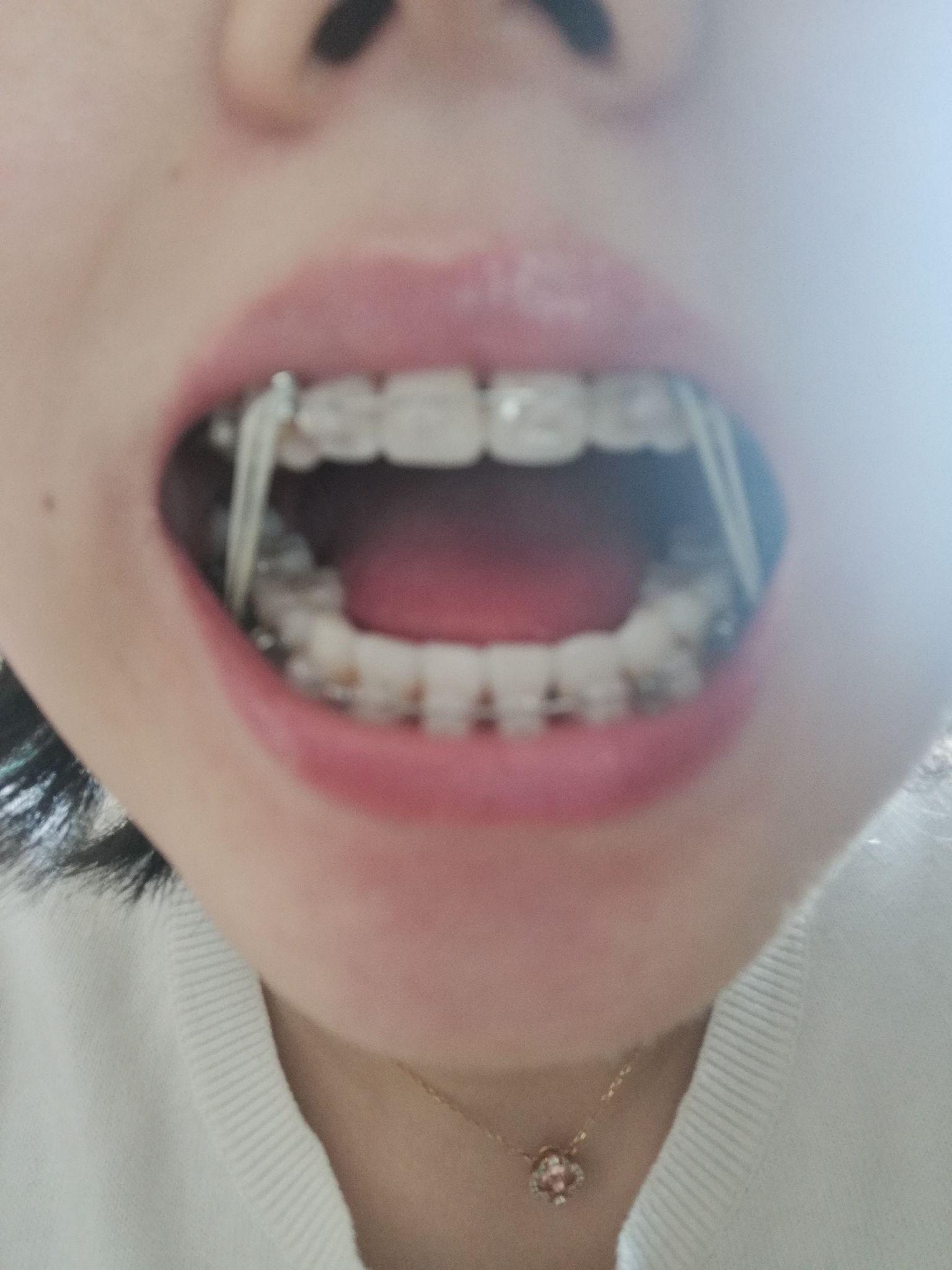 我的牙套生活（拔四颗牙齿+戴牙套+保持器） - 知乎
