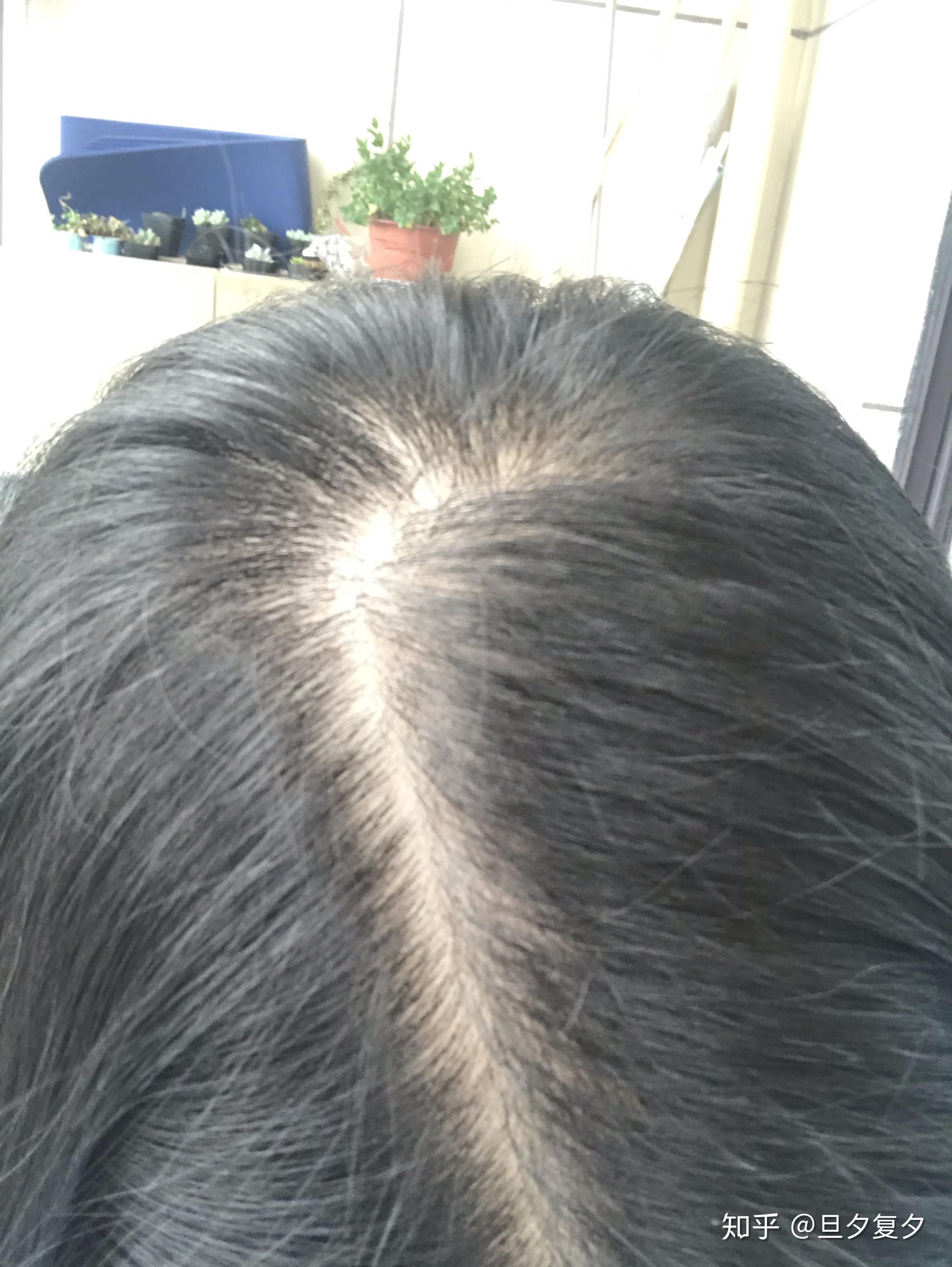 脂溢性三期治疗二个月对比照片_冠生祥脱发植发