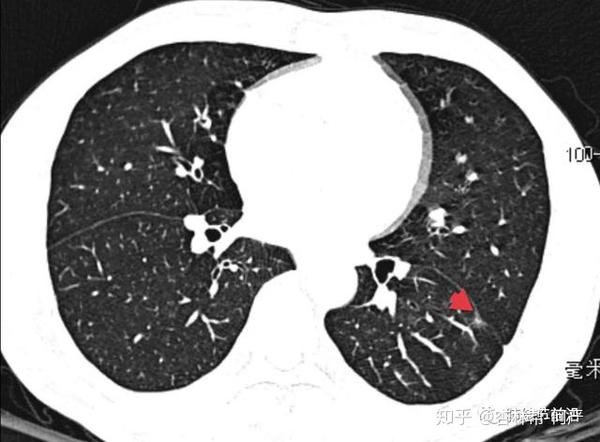 肺结节读片11磨玻璃结节胸膜侵犯的预测因素