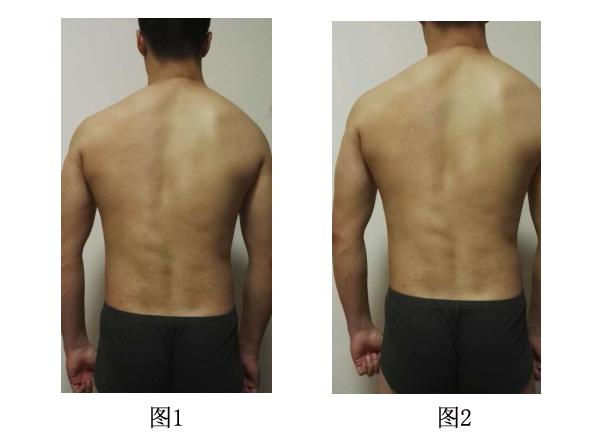 脊柱侧弯的简介和案例分析 - 知乎