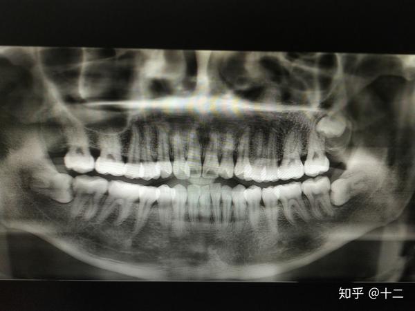 記錄一下成都華西口腔醫院拔智齒經歷